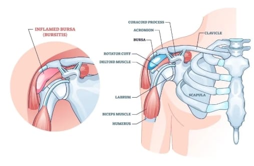 bursitis shoulder inflamed bursa